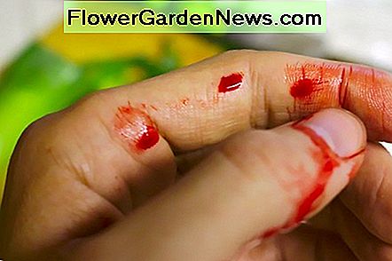 Gesneden wonden die steken nodig hebben, kunnen voorkomen bij het hanteren van afval. Cut wounds needing stiches can occur when handling trash.