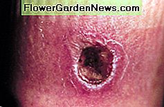 Auf diesem Foto haben Sie den Biss einer Brown Recluse Spider. Sie können den Schaden sehen, der durch den Biss einer dieser Spinnen entstehen kann. In this photo you have the bite of a Brown Recluse Spider. You can see the damage that can occur from the bite of one of these spiders.