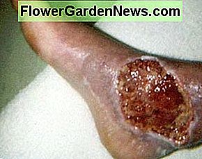 In diesem Foto ist das Ergebnis eines Brown Recluse Spider Biss. Die Frau sah die Spinne an ihrem Fuß, bevor sie sie biss. In this photo is the result of a Brown Recluse Spider Bite. The woman saw the spider on her foot before it bit her.