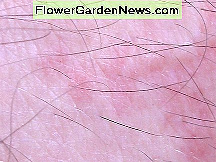 กัดอาจใช้เวลาเป็นชั่วโมงหรือหลายวันที่จะปรากฏบนผิว Bites may take hours or days to show up on the skin.