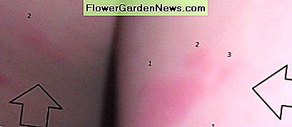 6 metų berniukų lova klaidų. A 6-year-old boy's bed bug bites.