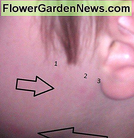 Nakvynė klaidų įkandimų dėl mažamečio veido. Bed bug bites on a toddler's face.