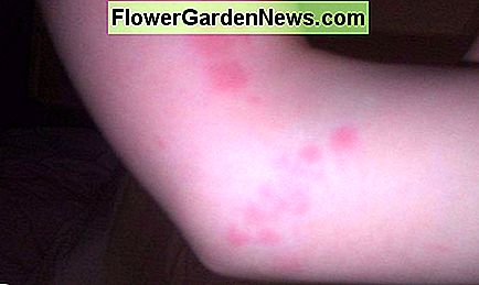 Nakties klaidos įkandimas ant vaiko alkūnės. Bed bug bites on a child's elbow.